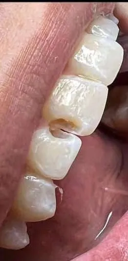 Caries interproximal restaurada con resina: antes