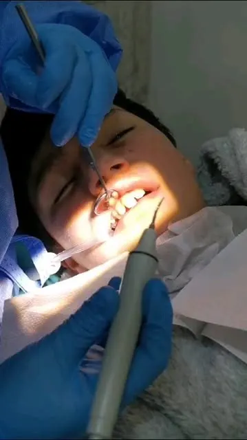 Limpieza dental en la consulta de DentalDent